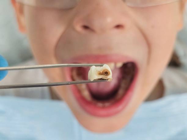 Best Urgent Care for Lost Fillings or Crowns in Long Beach, IN